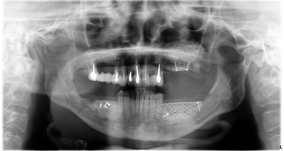 Костная пластика на нижней челюсти на снимке ОПТГ